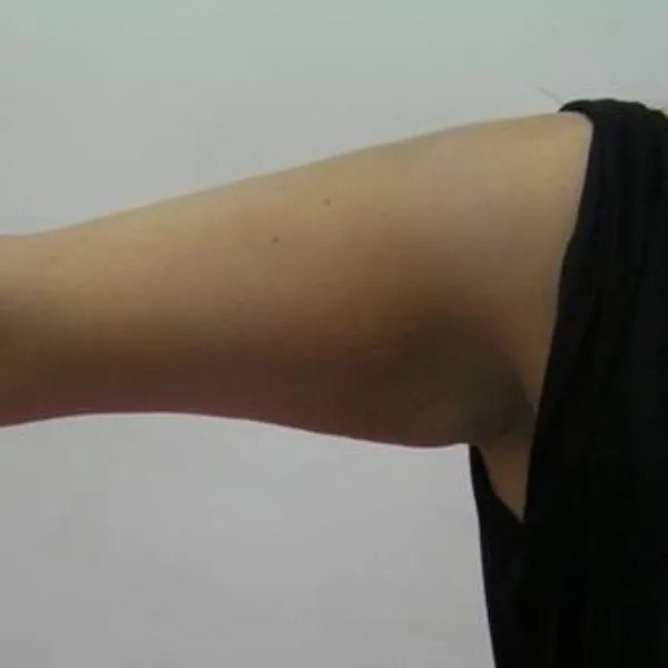 אחרי | טיפול בהיקף זרועות