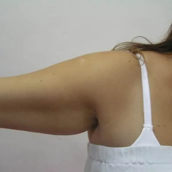 לפני | טיפול בהיקף זרועות