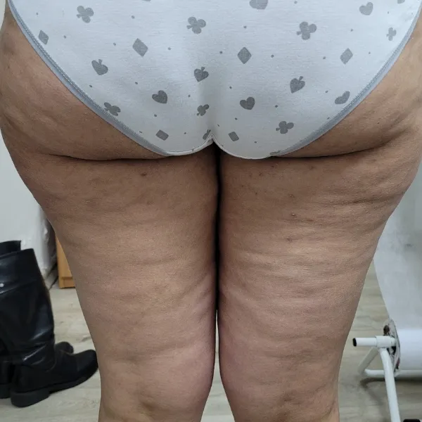 לפני | צלוליט