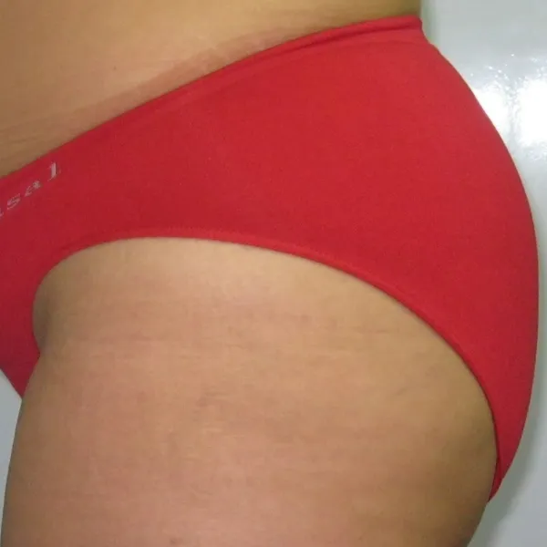 אחרי | צלוליט ישבן