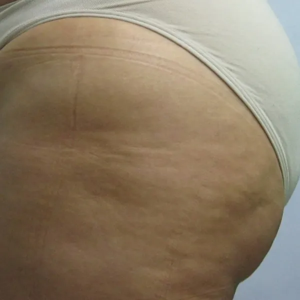 לפני | צלוליט ישבן