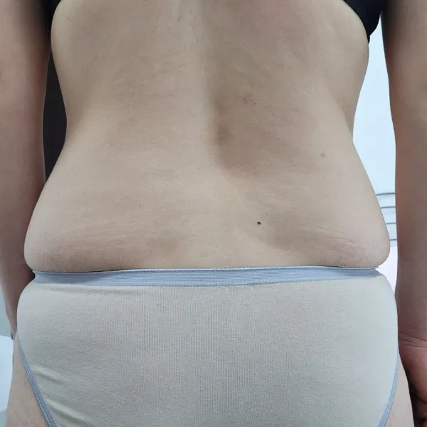 לפני | צמצום היקפים