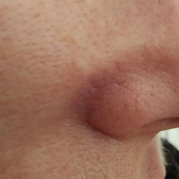 קופרוז | אחרי