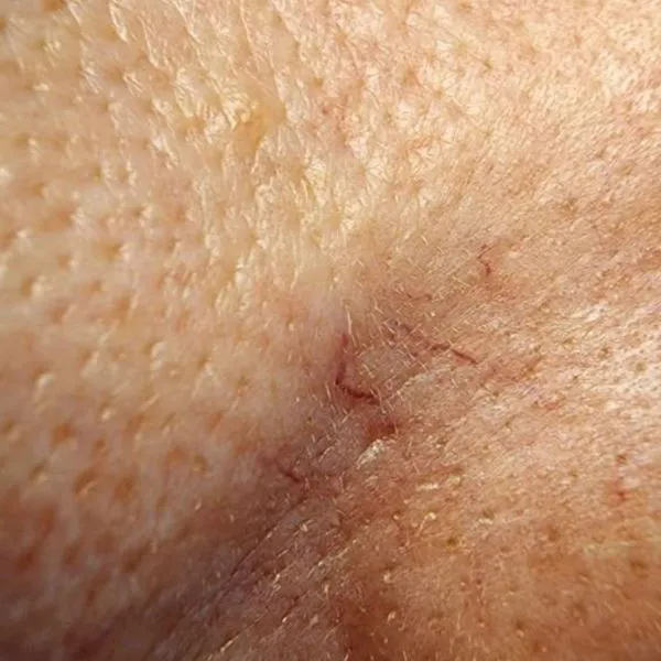 קופרוז | לפני