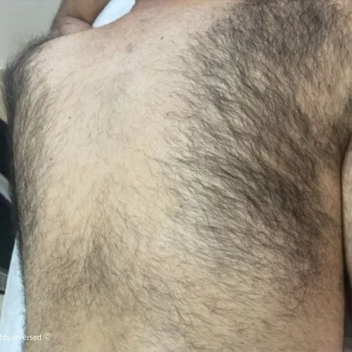 לפני | הסרת שיער