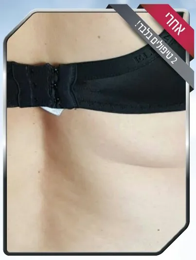 הצרת היקפים - אחרי