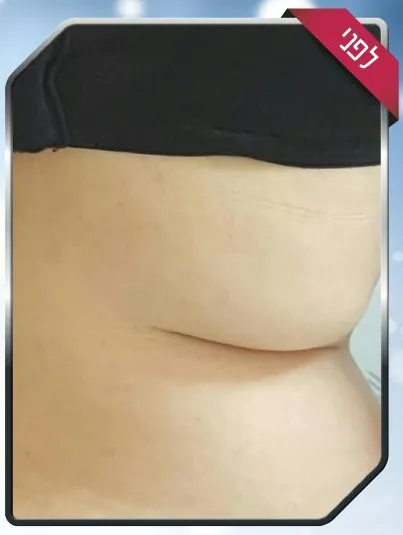 הצרת היקפים - לפני