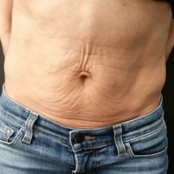 מיצוק העור | לפני