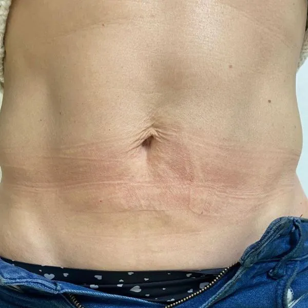 מיצוק העור | אחרי