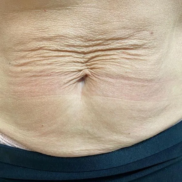 מיצוק העור | לפני