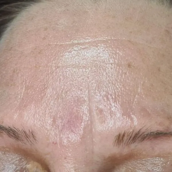 אחרי | מיצוק העור