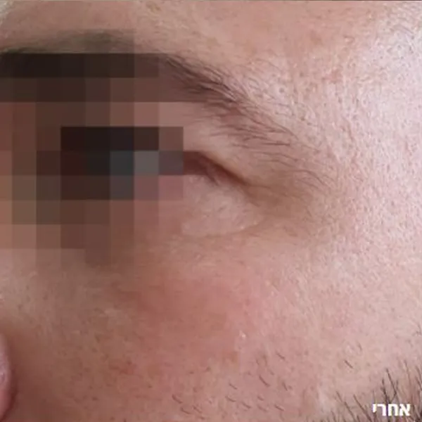 אחרי | מיצוק העור