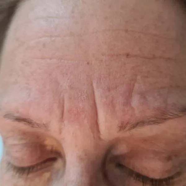 לפני | מיצוק העור