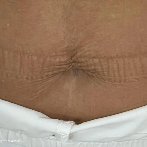 לפני | מיצוק מרקם העור