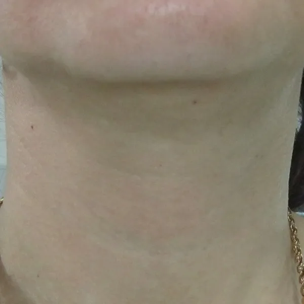 אחרי | טשטוש קמטי צוואר