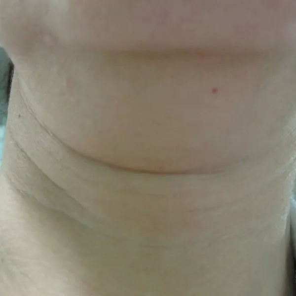 לפני | טשטוש קמטי צוואר