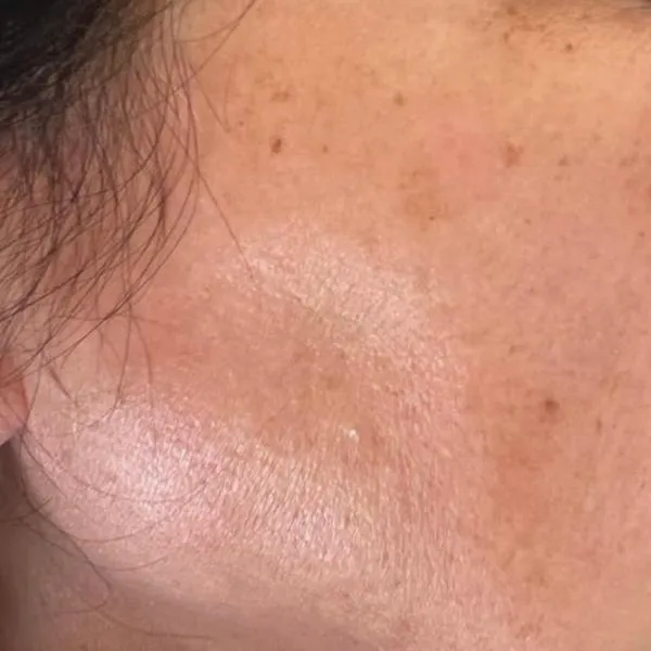 פגימנטציה | אחרי