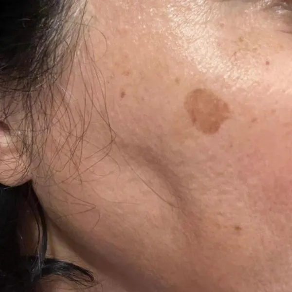 פגימנטציה | לפני