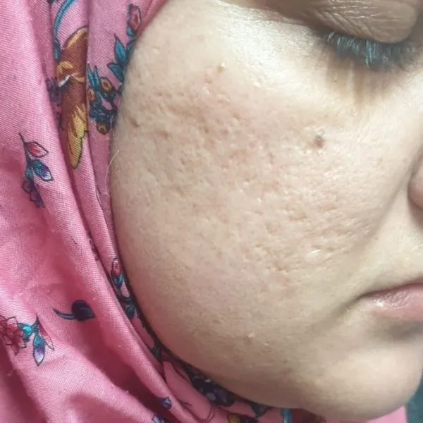 אחרי | צלקות פוסט אקנה