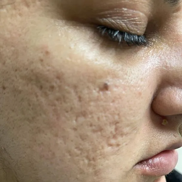 לפני | צלקות פוסט אקנה