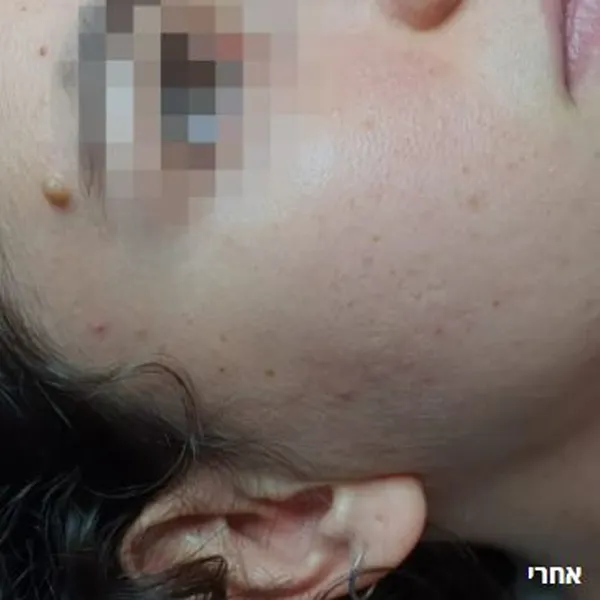 אחרי | טיפול בצלקות