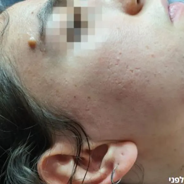 לפני | טיפול בצלקות