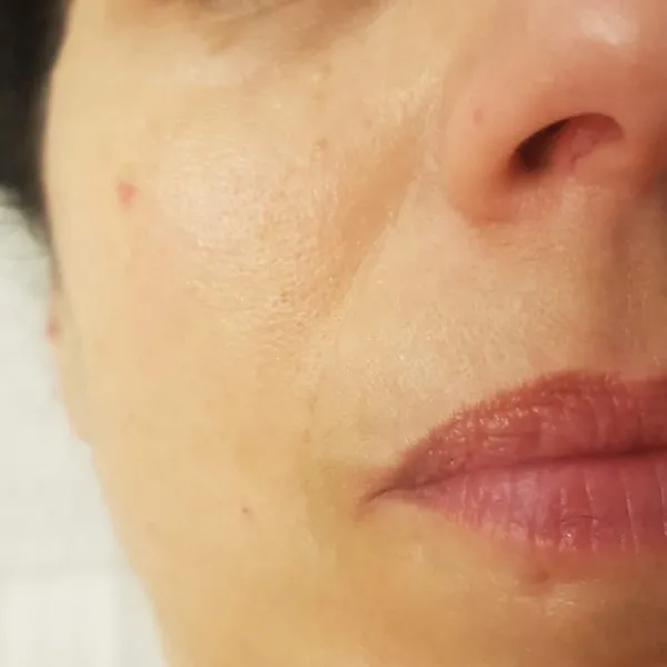 אחרי | טשטוש קמטים קיימים