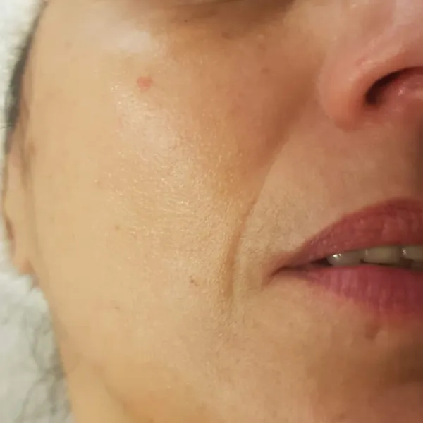 לפני | טשטוש קמטים קיימים