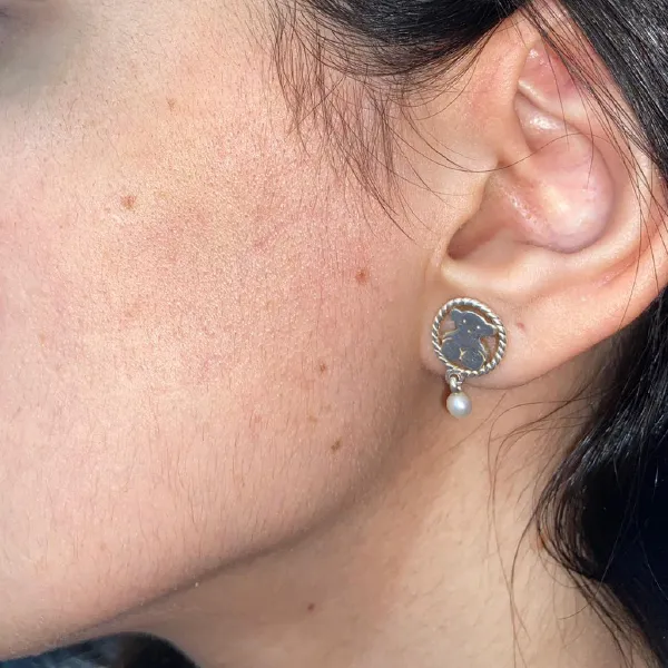 הסרת שיער פיאות | אחרי