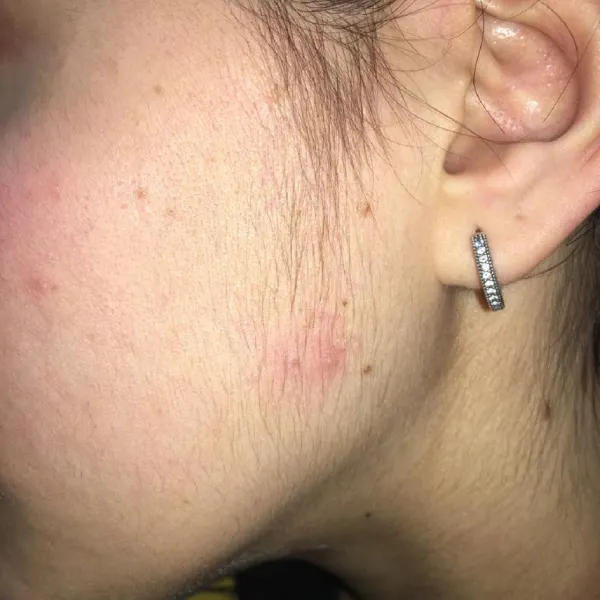 הסרת שיער פיאות | לפני