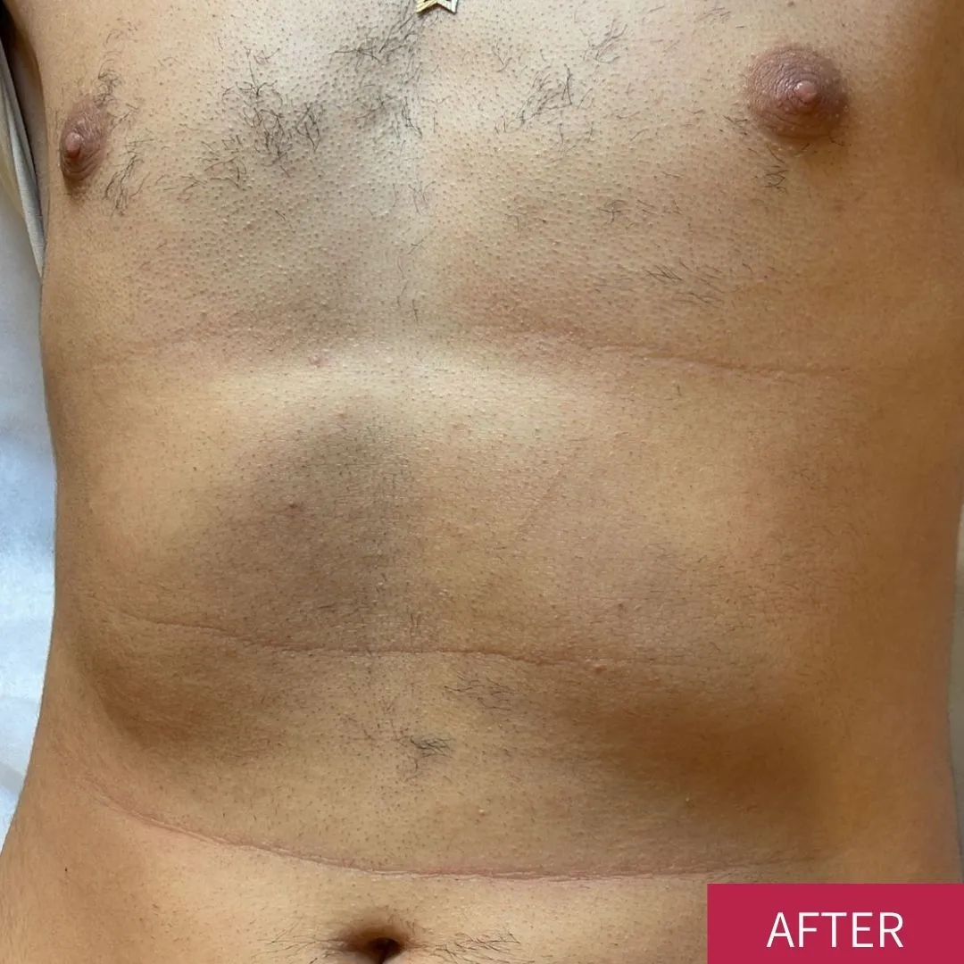 הסרת שיער | אחרי