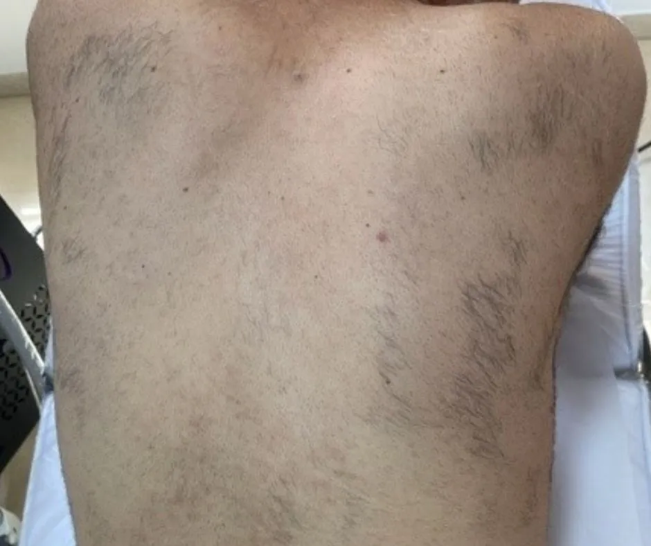 הסרת שיער | אחרי