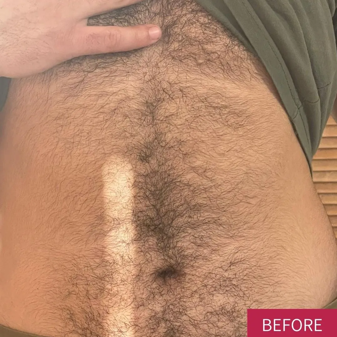 הסרת שיער | לפני