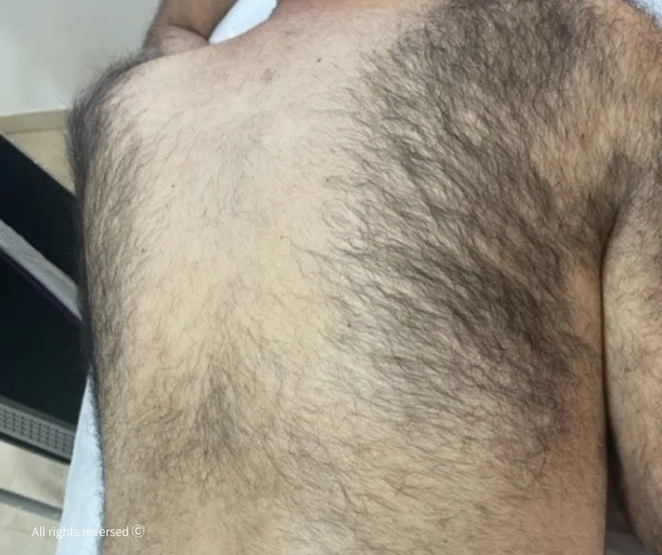 הסרת שיער | לפני