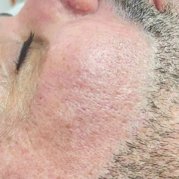 הסרת שיער | אחרי