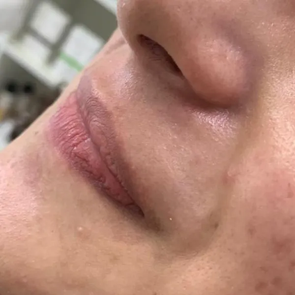 הסרת שיער | אחרי