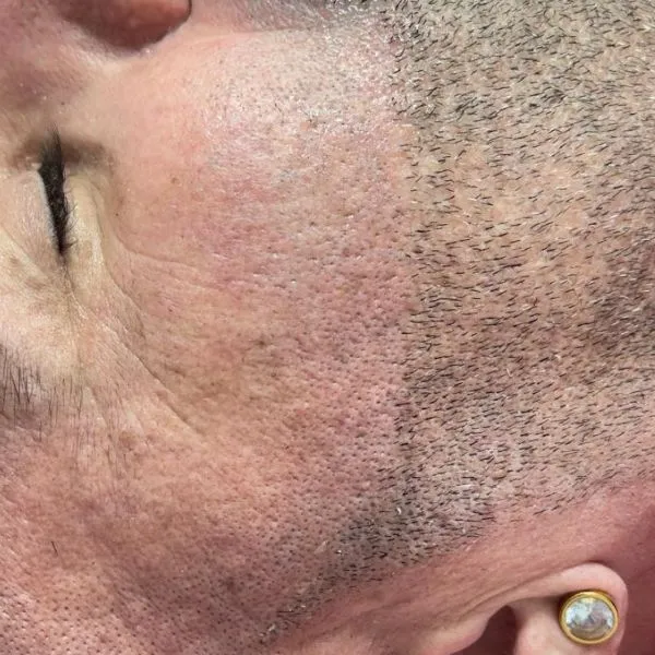 הסרת שיער | לפני