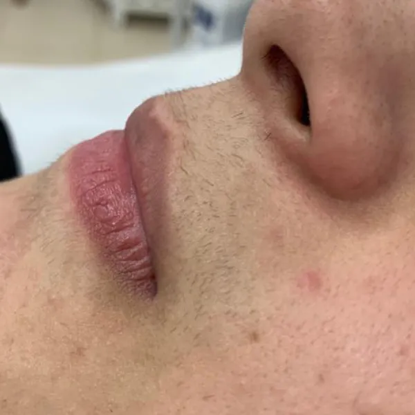 הסרת שיער | לפני