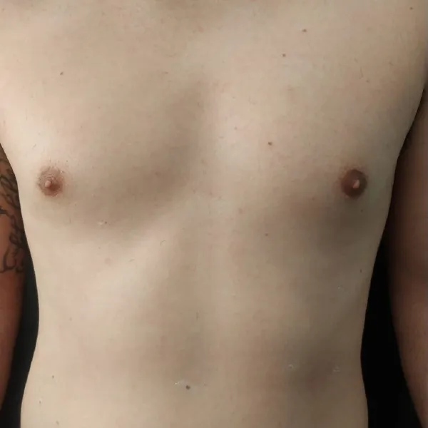 הסרת שיער | אחרי