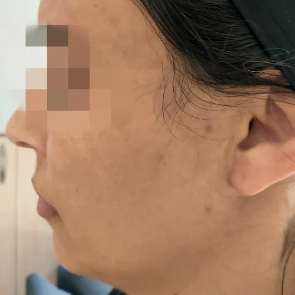 פיגמנטציה | אחרי