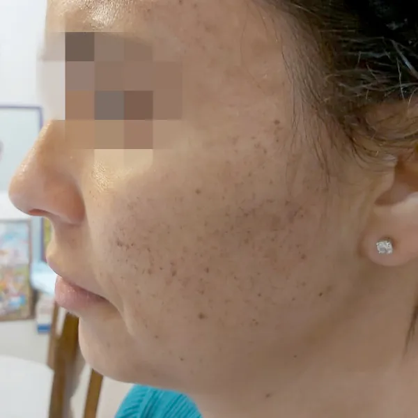 פיגמנטציה | לפני