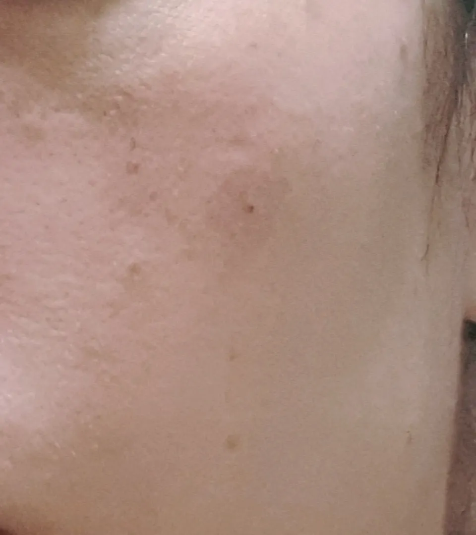 אחרי | פיגמנטציה