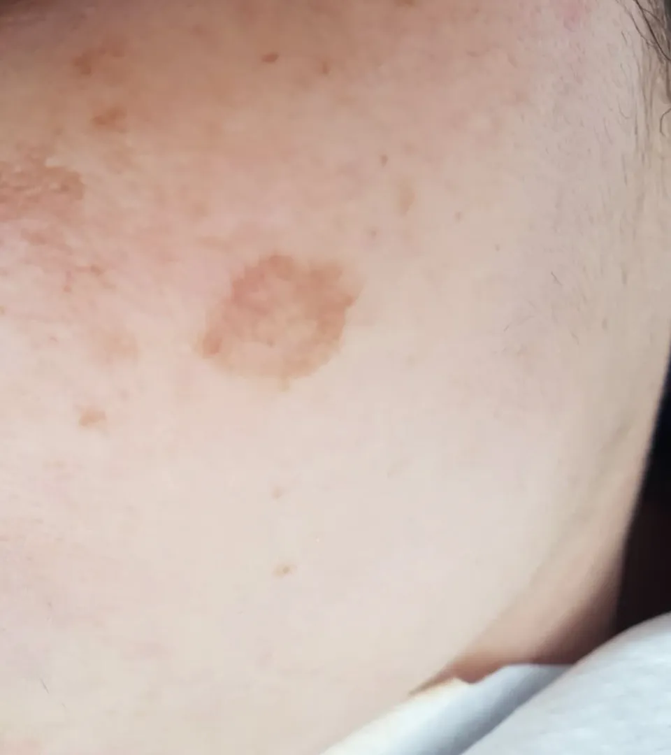 לפני | פיגמנטציה