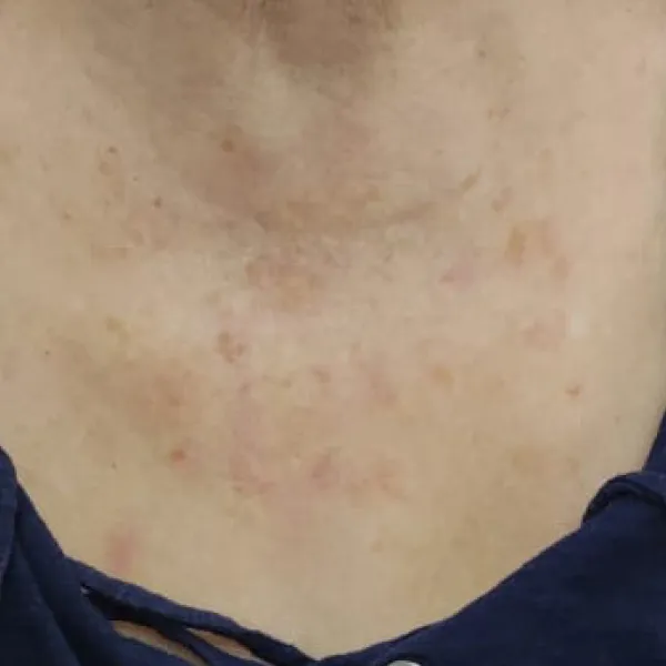 אחרי | פיגמנטציה