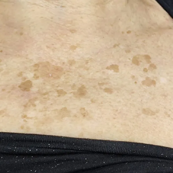 לפני | פיגמנטציה