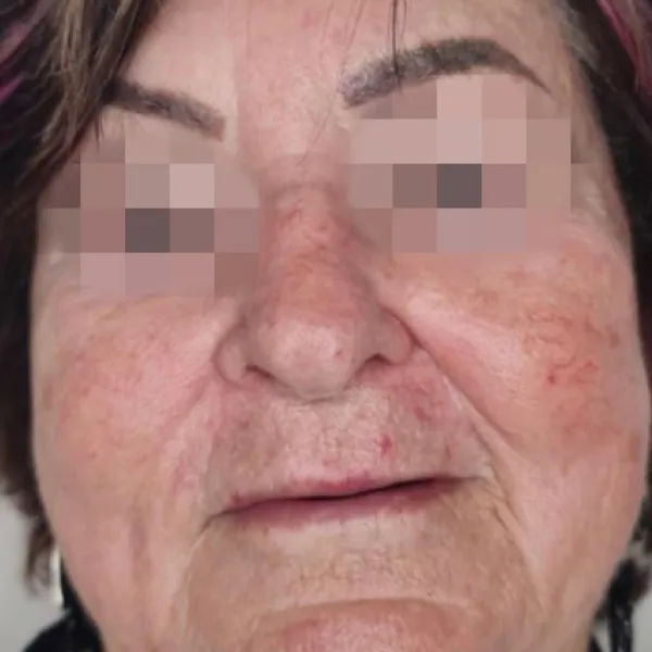 קופרוז | לפני